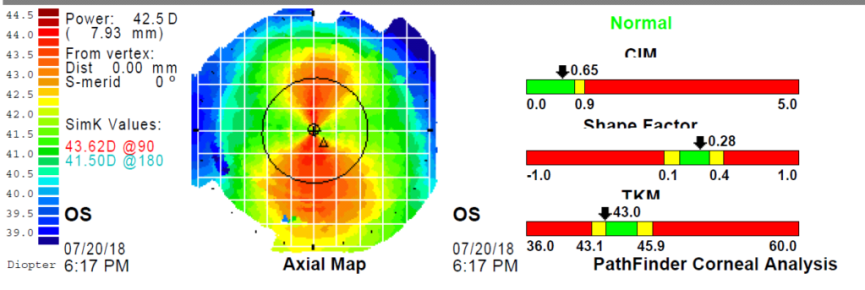 cornea-al-limite-3