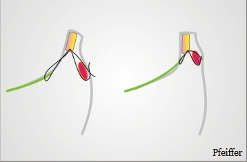 Imagen 12. Reaplicación de los retractores con suturas dobles. La sutura pasa primero por los retractores verde) a continuación por el tarso (amarillo) y finalmente por el orbicular (rojo).