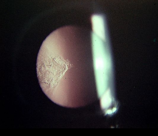 Fig. 9.- Catarata sub capsular posterior en pterigión. Parece la proyección de la sombra del pterigión. Este aspecto solo se observa en los pacientes irradiados con beta-terapia.