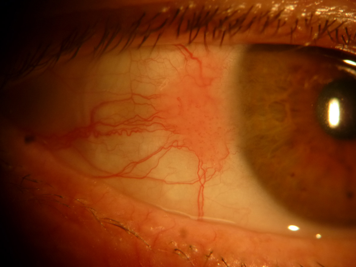 Human papilloma virus ocular Virusul papiloma uman poate provoca cistită