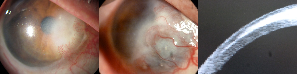 Figura 4. Rodríguez-Ausín y col. A new Oct sign of invasive squamous cell carcinoma of the cornea. Arch Soc Esp Oftalmol. 2016 Feb; 91(2):90-3