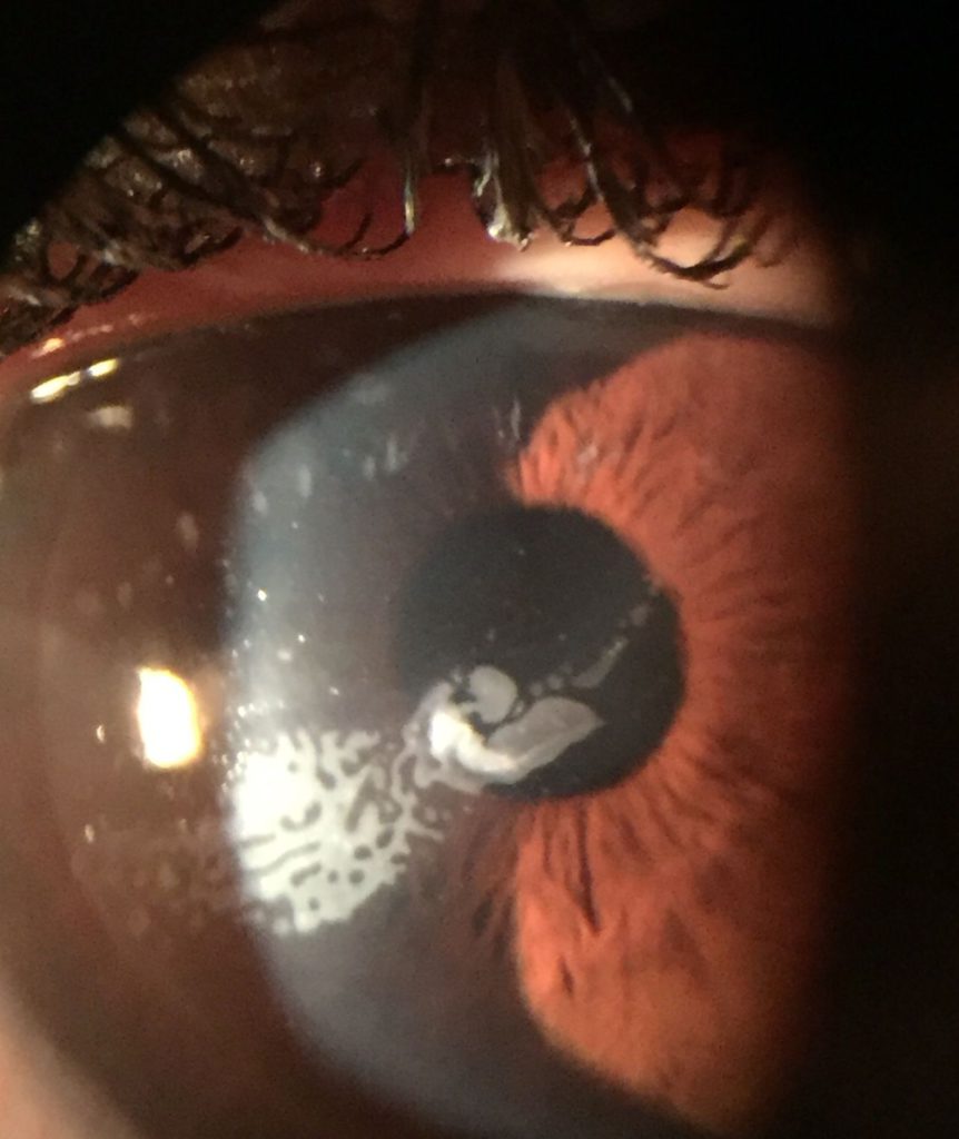 Imagen típica de un CE grado 3 que se extiende hacia el eje visual afectando a la visión del paciente.