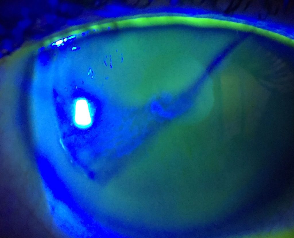 Irregularidad en la superficie corneal anterior evidenciada mediante fluoresceína en el caso anterior.