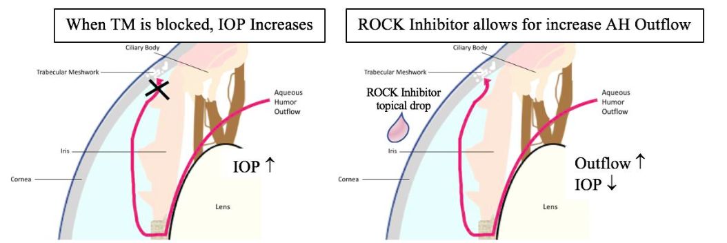 Figura 4: Vista simplificada del tratamiento del glaucoma utilizando gotas inhibidoras ROCK. TM: Malla Trabecular; PIO: presión intraocular; Inhibidor de la ROCK: inhibidor de la quinasa rho; AH: Humor acuoso.