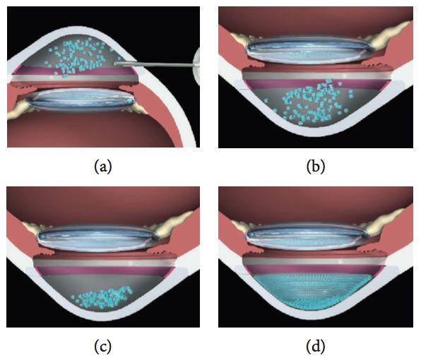 Figura 15: Imágenes esquemáticas de la terapia de inyección de células endoteliales corneales cultivadas (CEC). (a) Coinyección de CEC cultivadas con un inhibidor de ROCK en la cámara anterior; (b) paciente en posición boca abajo, para permitir que los CEC se hundan hacia el lado de la cámara anterior de la córnea; (c) mantenimiento de la posición boca abajo durante 3 horas; (d) regeneración del endotelio corneal por los CEC cultivados inyectados. Reproducido de Okumura et al. “Rho kinase inhibitor enables cell-based therapy for corneal endothelial dysfunction”