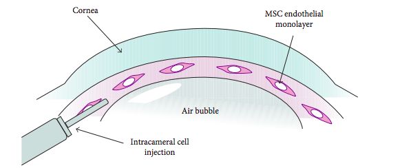 Figura 18: Diagrama esquemático que muestra la inyección de células madre mesenquimales en la cámara anterior con una interfaz córnea-aire (actualmente bajo evaluación en modelos animales)