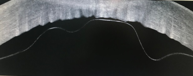 Figura 1. OCT de Segmento Anterior del OS la paciente donde se observa un desprendimiento extenso de la MD, la cual forma una pseudocamara de bordes sinuosos que contiene un material hipointenso.