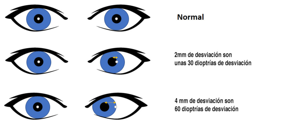 Test de Hirschberg