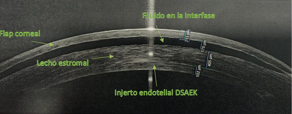 Ilustración 1. Imagen aportada por el Dr.Balparda. Tomografía de coherencia óptica de segmento anterior donde se muestra el fluido en la interfase, entre el flap formado por el LASIK y el lecho estromal residual.