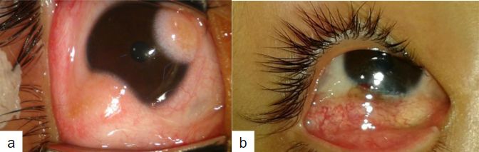 Imagen 10. (a) Dermoides limbares y su resolución (b) luego de 2 semanas con injerto de conjuntiva y células madre(25)