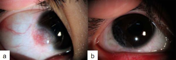 Imagen 11. (a) Lesión pre quirúrgica. (b) lesión post escisión y tatuaje corneal