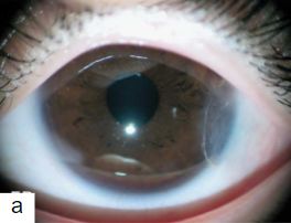 Imagen 14. Injerto corneal con opacidad moderada