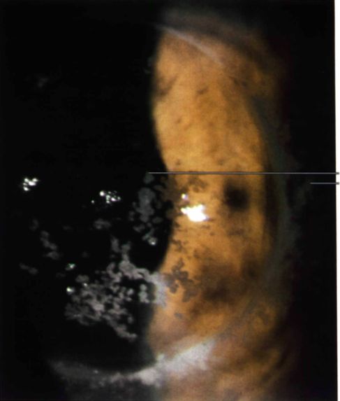 Distrofia granular recidivada en un injerto. Nótese las flechas apuntando al borde del injerto y a las recidivas