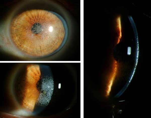 Fotos de la lámpara de hendidura del ojo izquierdo que muestran opacidades blancas granulares ubicadas al nivel de la interfaz de aleta LASIK. Fuente: eyerounds.com