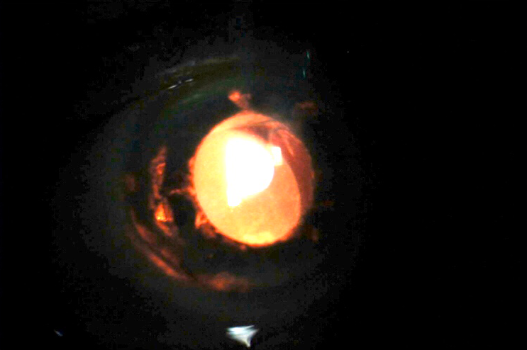 Figura 1. Imagen facilitada por el Dr. Rodrigo González dónde se aprecia por retroiluminación el defecto iridiano a nivel temporal en relación con el háptico de la lente intraocular.