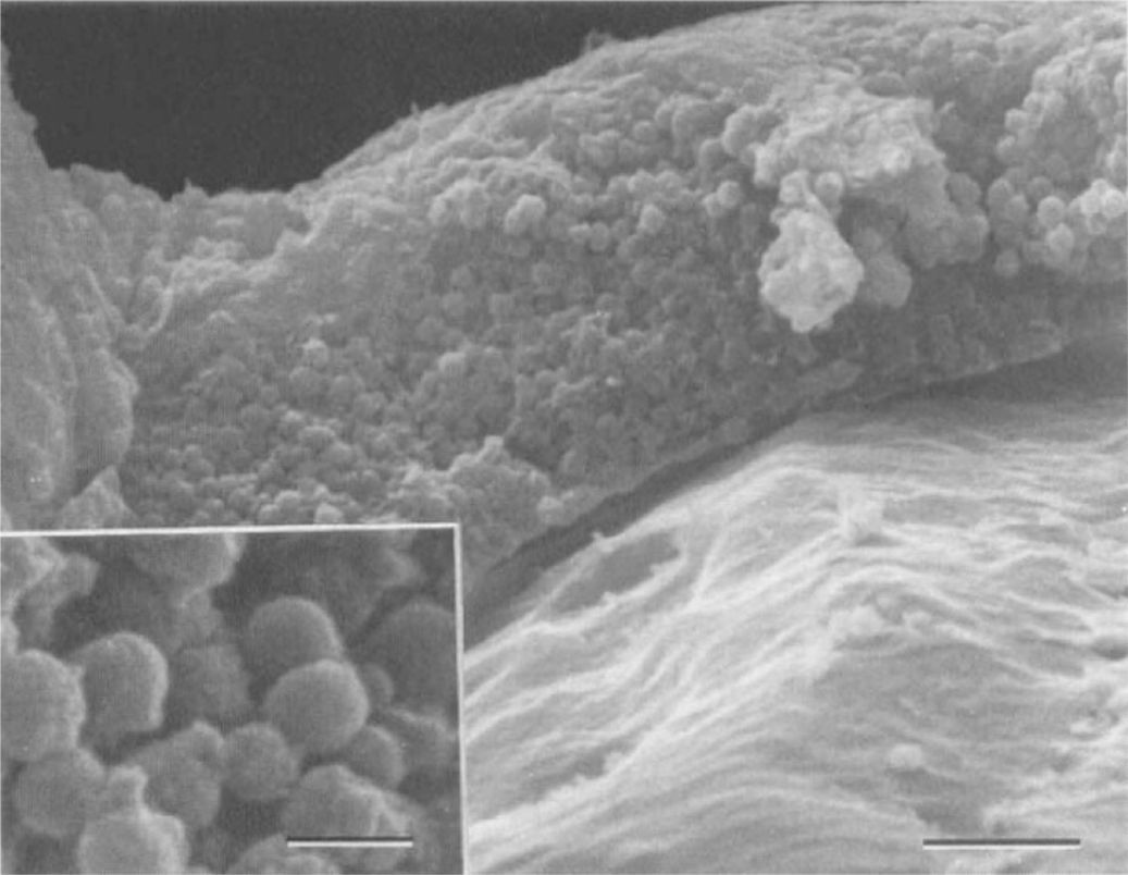 Figura 2. Imagen de microscopía electrónica mostrando el material cocoide adherido al háptico de la LIO (Escala 5 µm). Recuadro inferior izquierdo mostrando detalle estructural aumentado (Escala 1 µm). Fuente: Asaria et al.