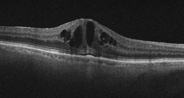 Figura 1. Edema macular cistoide tras cirugía de cataratas visto en OCT.